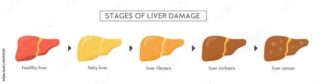 Stages of liver disease